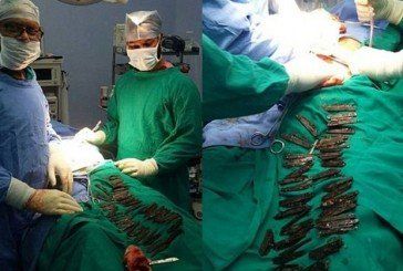 Індійські хірурги знайшли у шлунку пацієнта 40 ножів