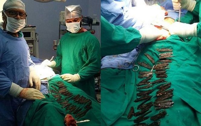 Індійські хірурги знайшли у шлунку пацієнта 40 ножів
