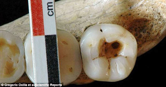 Стоматологи льодовикового періоду: вчені у захваті від зубних пломб віком 14 тисяч років (ФОТО)