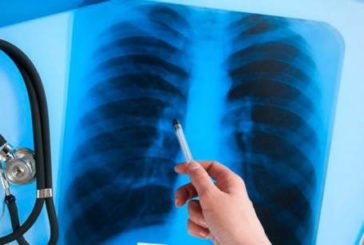 Тест на туберкульоз можна зробити в інтернеті